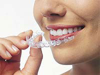 Image of Invisalign Clear Liners Falls Church VA