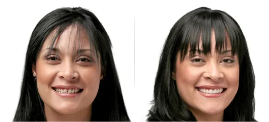 Image Of Before And After Lumineers Porcelain Veneers Falls Church VA