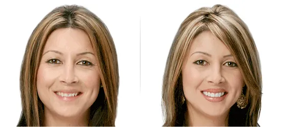 Image Of Before And After Lumineers Porcelain Veneers Falls Church VA